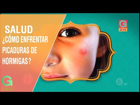 Vídeo: Picadura De Hormiga: Picadura De Hormiga Roja Y Roja, Beneficios, Consecuencias Y Tratamiento