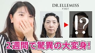ドクターエルミスファースト】衝撃ビフォーアフター【2週間チャレンジ