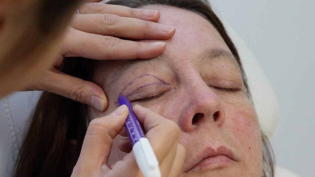 Ooglidcorrectie (boven) - Hoe verloopt de ingreep?