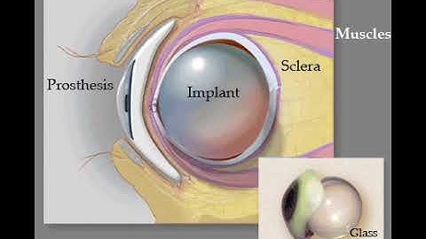 Ocular Implant and Prosthesis after Evisceration
