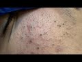 Deep Cleansing Techniques For Acne — Best Remedies For Blackheads