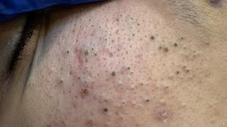 Deep Cleansing Techniques For Acne — Best Remedies For Blackheads