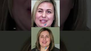 Esercizi Per Il Recupero Post Paralisi Del Nervo Facciale Nel Caso Di Monica