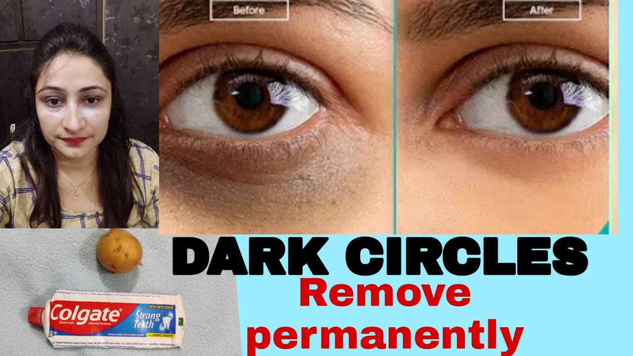 How To Get Rid of DARK CIRCLES At Home Permanently घर पर काले घेरे