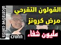  القولون التقرحي مرض كرونز ربما هذا هو آخر حل للشفاء  