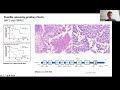 Eans webinar meningiomas