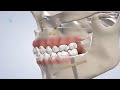Post-Operative Instructions: Orthognathic Surgery (1st wk) | Oral Surgery Specialists of Oklahoma