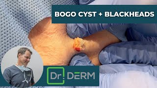 BOGO Cyst and Blackheads | Dr. Derm