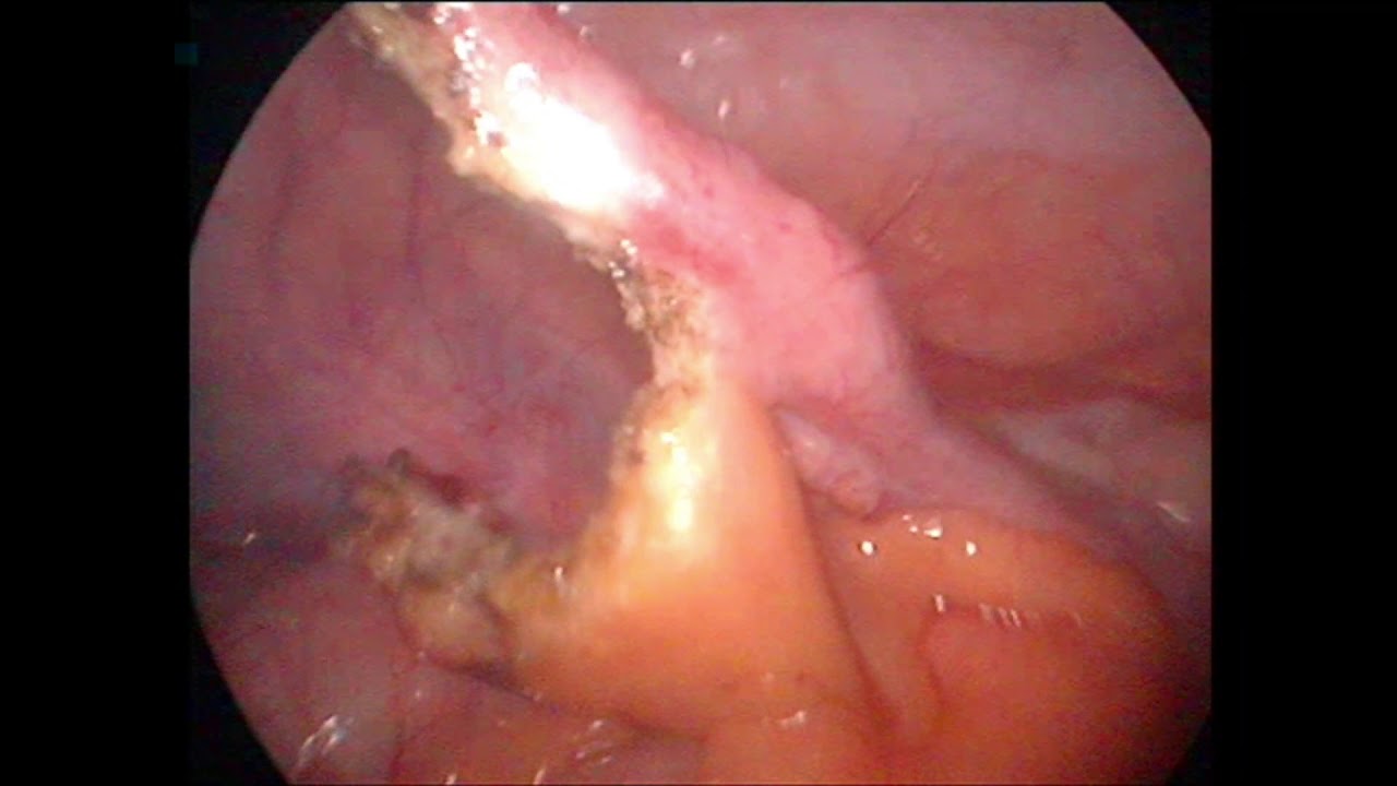 Laparoscopic appendectomy for acute appendicitis in female