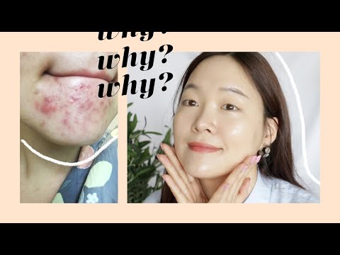 the reason why you keep on getting acne