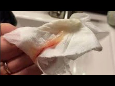 نزول افرازات بخيوط دم هل تدل على حدوث حملك في ايام التبويض