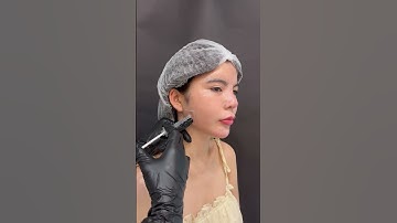 CẬN CẢNH QUÁ TRÌNH TIÊM THON GỌN HÀM