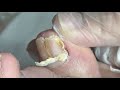 Immediate pain relief for nails(difficult case but fast done)