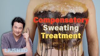 Compensatory Hyperhidrosis Treatment: Lasting Comfort with Noninvasive Sweat Gland Thermolysis!