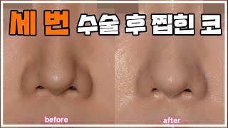 세번의 수술 후 찝혀버린 코....