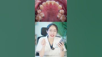 Bác sĩ khắc phục tình trạng răng khấp khểnh như thế nào? | Lạc Việt Intech Niềng Răng #shorts