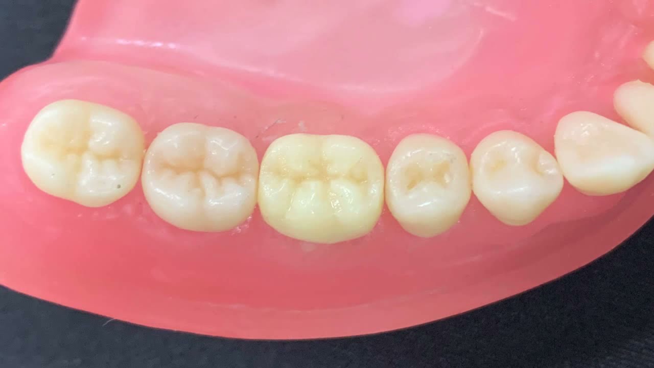 Restauração provisória indireta/ coroa provisória - técnica da “bolinha” ou da “massa grossa”
