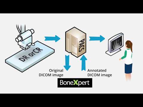 Bone age automated with BoneXpert AI - precise and easy
