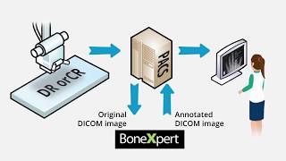 Bone age automated with BoneXpert AI - precise and easy screenshot 1