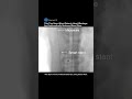 Self-Powered Smart Stent Detects Artery Blockage Early Using AI #stent #cardiology #medical #shorts