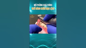 Mô Phỏng Kỹ Thuật Nhổ Răng Khôn Mọc Lệch Tại DC Dentist