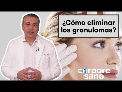Vídeo: Granuloma: Tratamiento De Granulomas Con Remedios Y Métodos Populares