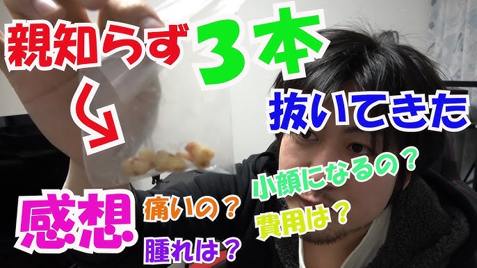抜き歯 親知らず3本同時で抜いてきた 感想 痛すぎたw Youtube 抜き歯 親知らず3本同時で抜いてきた 感想 痛すぎたw Youtube