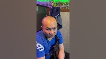 Kết quả sau 10 ngày điều trị hói nửa đầu của vị khách đến từ korea