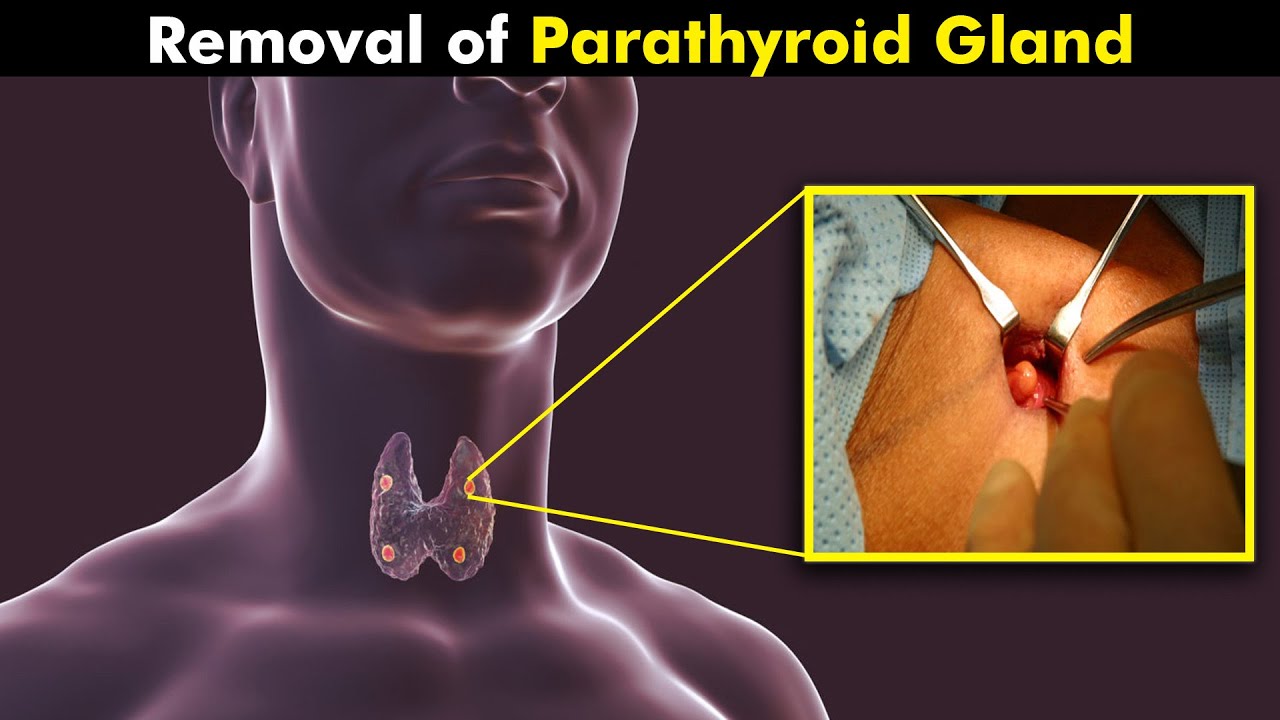 How Parathyroid Gland Surgery Is Performed? (Urdu/Hindi)