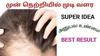 mun netriyil mudi valara tips in tamil | முன் நெற்றியில் முடி வளர | how grow hair front of forehead
