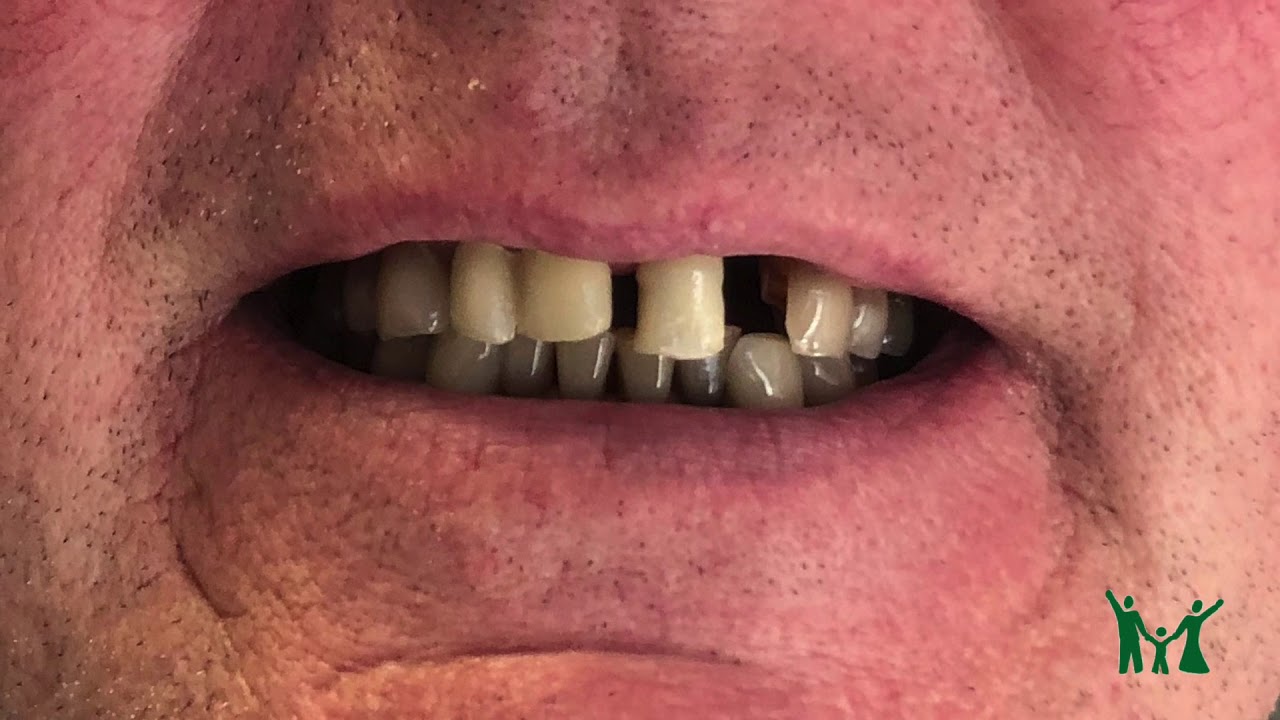 Smile Transformation! Bradshaw Family Dental YouTube