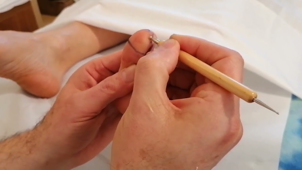 Reflessologia plantare :  riflesso della  Corteccia Prefrontale