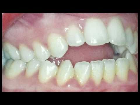 FASTBRACES  ABOUT