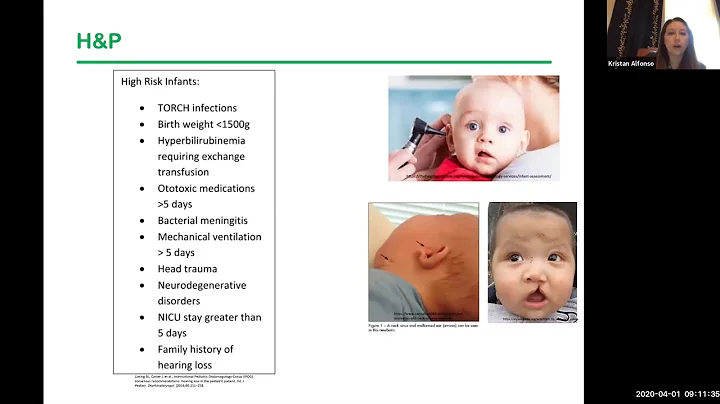 Approach to Pediatric Sensorineural Hearing Loss - Dr. Kristan Alfonso