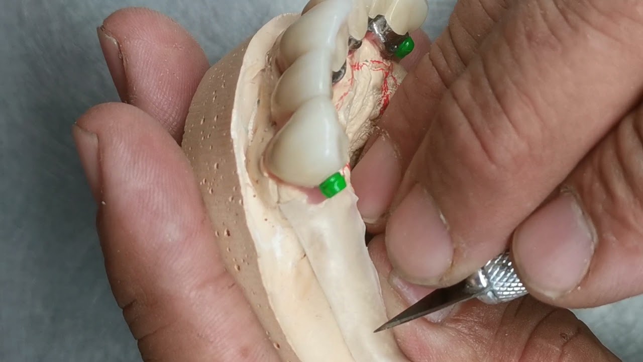 Protesis removible con aditamentos. Roberto González