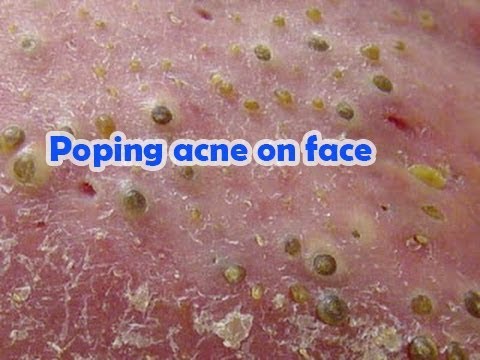 Worst Cystic Acne, Zits, Pimples, Blackheads and Whiteheads Extraction, Adult Facial Treatment, 