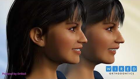 Treatment for Overjet (overbite) in Toronto