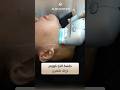 جلسة الترا فورمر لإذابة اللغلوغ بطريقة مضمونة وسريعة وبدون اي تدخل جراحي عيادات الشاكرين تجميل 