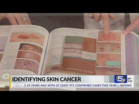 VIDEO: How to identify skin cancer