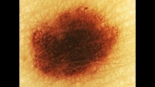 Things Up Close: Mole on Skin
