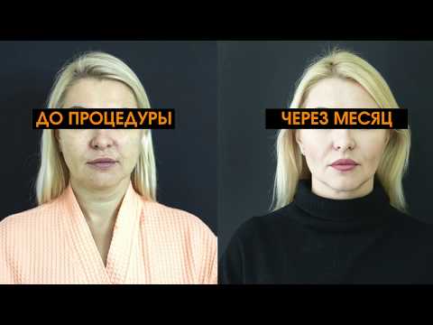 Видео: Sculptra: эффективность процедур омоложения кожи