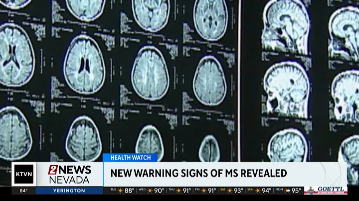 New findings show multiple sclerosis may exist before symptoms show