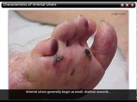 Characteristics of Arterial Ulcers