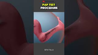 What actually happens during a Pap test? #paptest #womenshealth