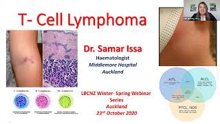 T cell lymphoma presented by Dr Samar Issa