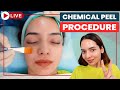 💁‍♀️ CHEMICAL PEELS - Step by Step | Chemical Peels for Acne Scars | SkinQure, Delhi