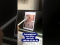 Gemangioma lazer bilan