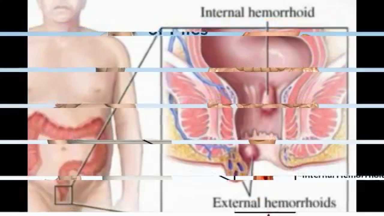 How to get rid of hemorrhoids - YouTube