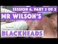 Mr Wilson's Blackhead Extractions: Session 6, Part 2 of 2