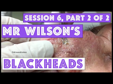 Mr Wilson's Blackhead Extractions: Session 6, Part 2 Of 2